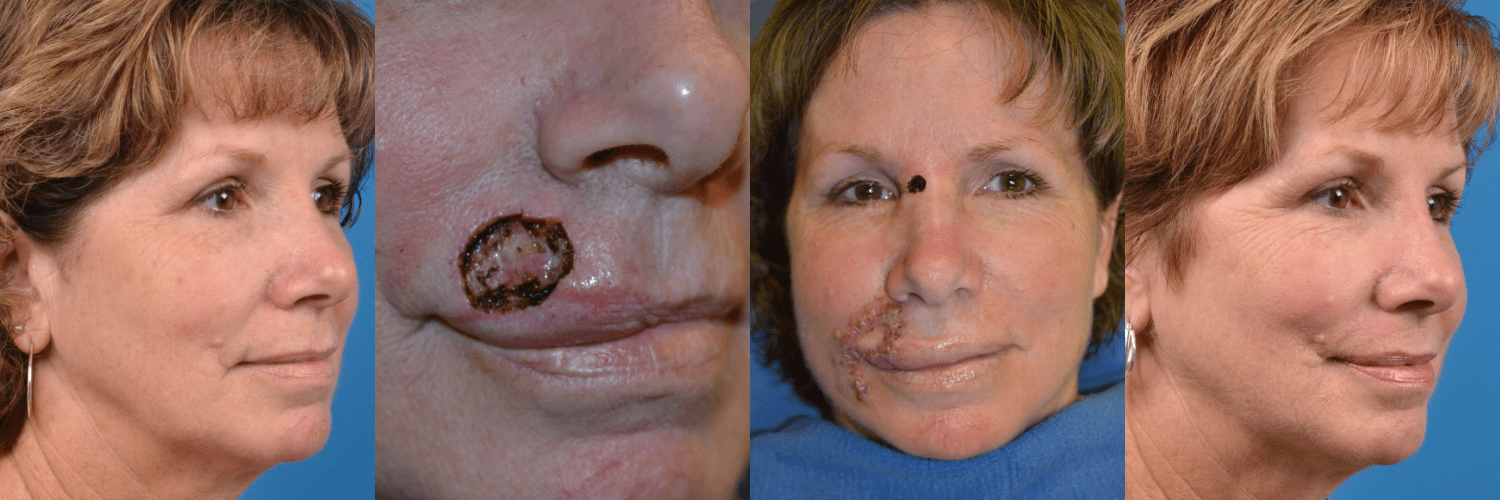 Mohs Surgery and Skin Cancer Photos Melbourne, FL